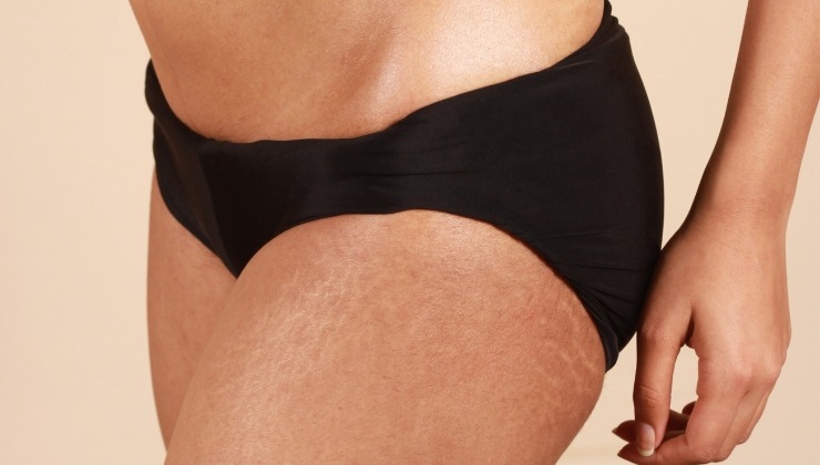 Cellulite il consiglio per eliminarla