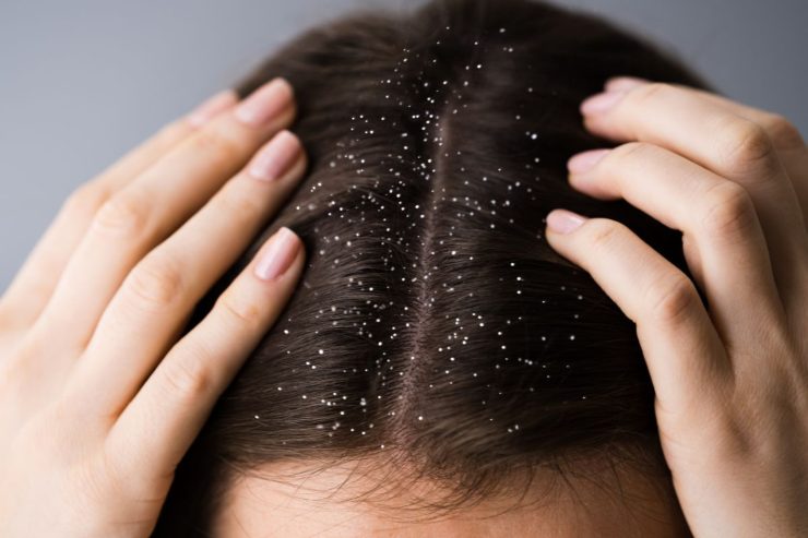 dandruff caused by 4 habits