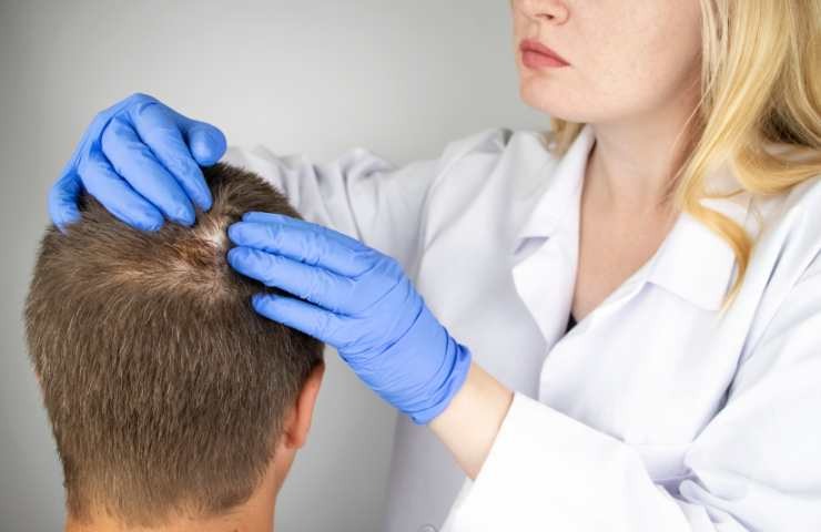 alopecia il rimedio migliore