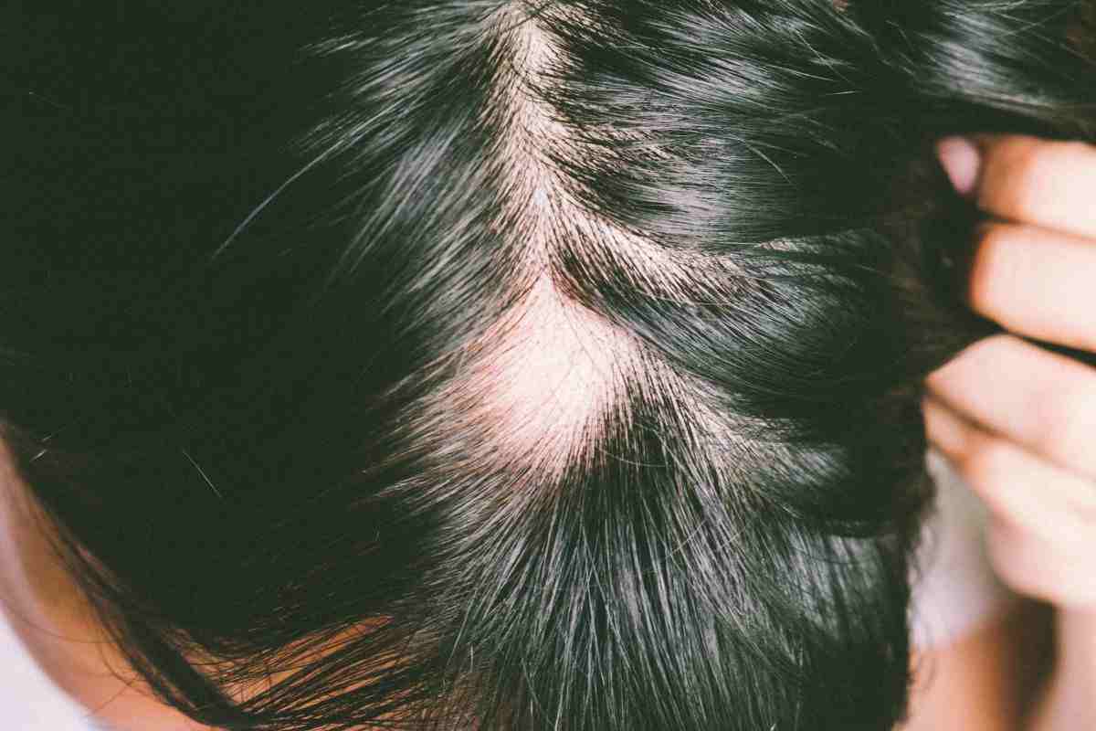 alopecia trovata cura
