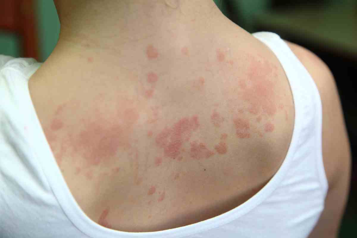 Dermatite da sudore, i rimedi più efficaci