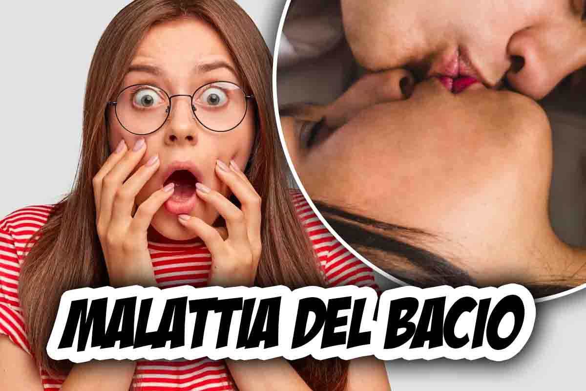 Malattia del bacio, cos'è e come si cura